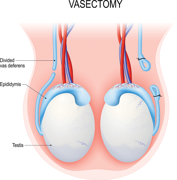 Illustration of testes, epididymides, and vasa deferentia. One vas deferens has been cut. The other vas deferens has been cut and tied closed.