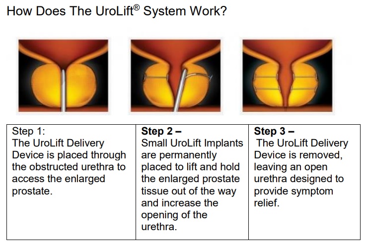 How does the UroLift System Work?