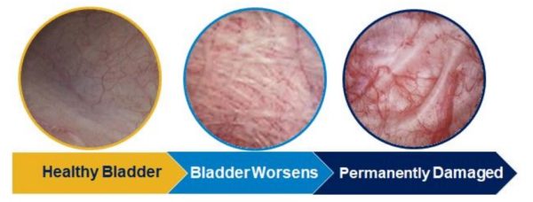 Image showing progression of bladder damage