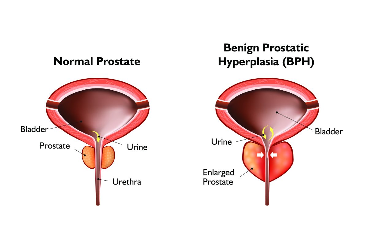 Image showing normal and enlarged prostate